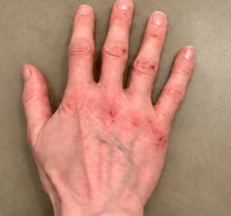 Founder’s hand after 14 days of a regular alcohol-based sanitizer: red, cracked skin across the knuckles and back of the hand